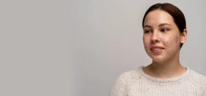 Acne & Acne Scar Treat